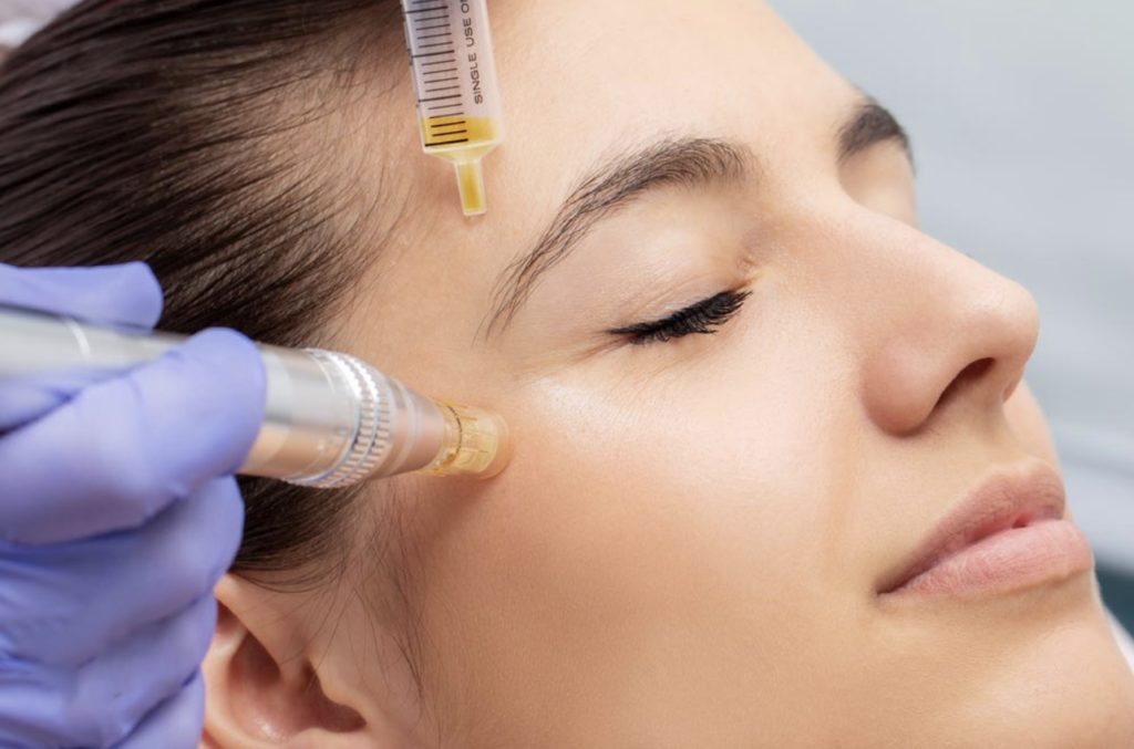 A Woman is getting Microneedling with Exosomes | The BB Organics in West Hartford, CT.